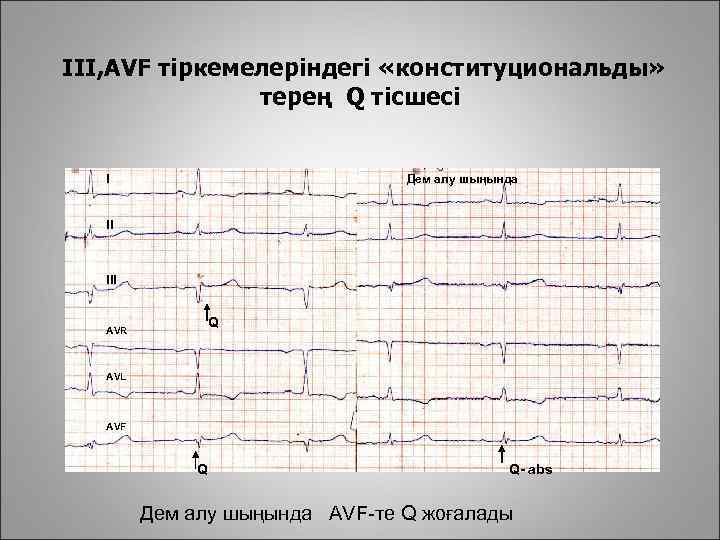 III, AVF тіркемелеріндегі «конституциональды» терең Q тісшесі I Дем алу шыңында II III Q