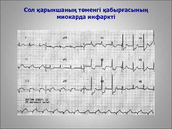 Сол қарыншаның төменгі қабырғасының миокарда инфаркті 