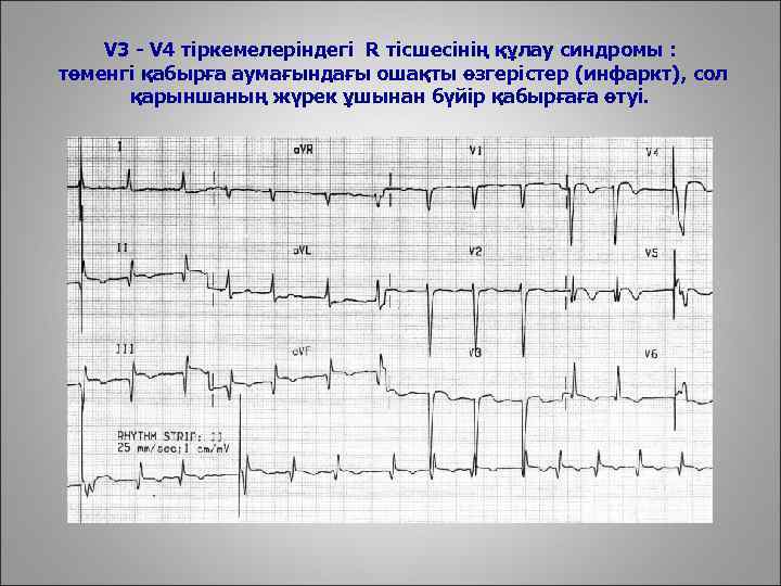 V 3 - V 4 тіркемелеріндегі R тісшесінің құлау синдромы : төменгі қабырға аумағындағы