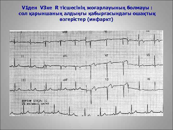 V 1 ден V 3 ке R тісшесінің жоғарлауының болмауы : сол қарыншаның алдыңғы