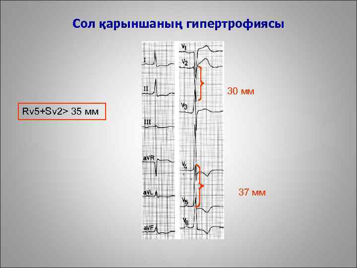 Сол қарыншаның гипертрофиясы 30 мм Rv 5+Sv 2> 35 мм 37 мм 