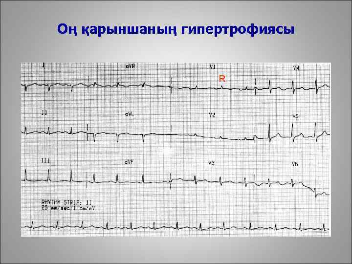 Оң қарыншаның гипертрофиясы R 