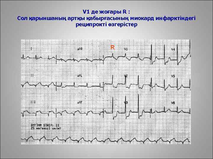 V 1 де жоғары R : Сол қарыншаның артқы қабырғасының миокард инфарктіндегі реципрокті өзгерістер