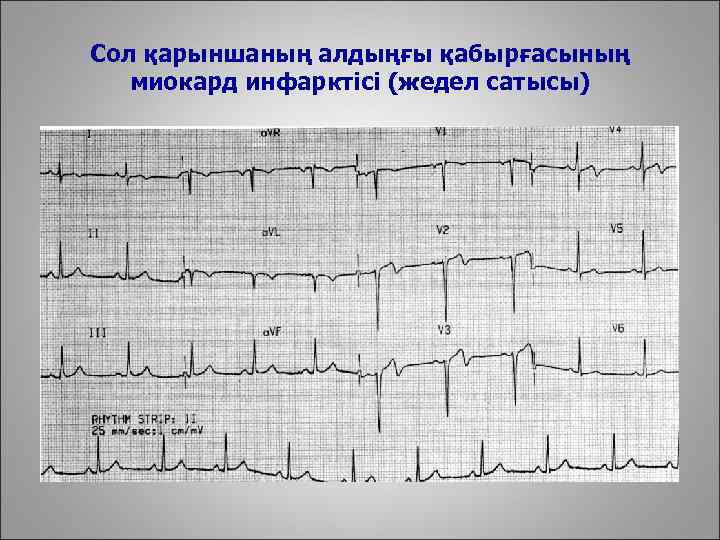 Сол қарыншаның алдыңғы қабырғасының миокард инфарктісі (жедел сатысы) 