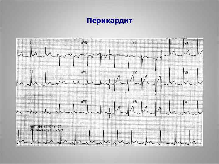 Перикардит 