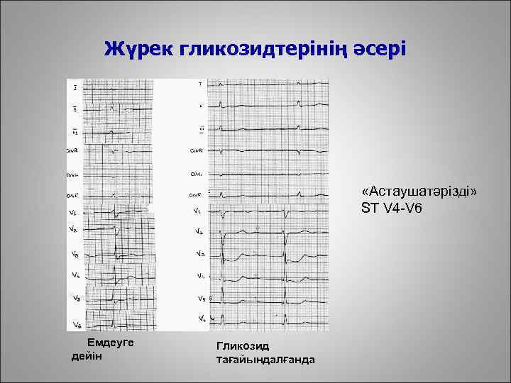 Жүрек гликозидтерінің әсері «Астаушатәрізді» ST V 4 -V 6 Емдеуге дейін Гликозид тағайындалғанда 