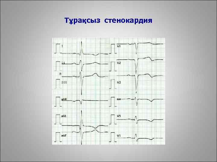 Тұрақсыз стенокардия 