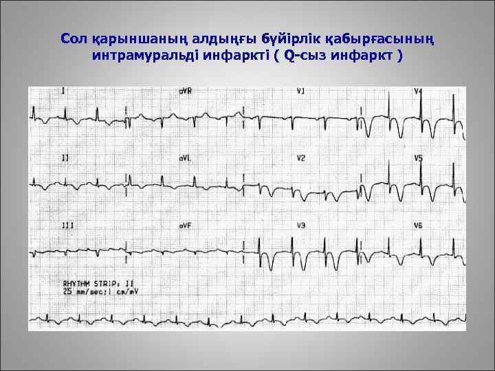 Сол қарыншаның алдыңғы бүйірлік қабырғасының интрамуральді инфаркті ( Q-сыз инфаркт ) 