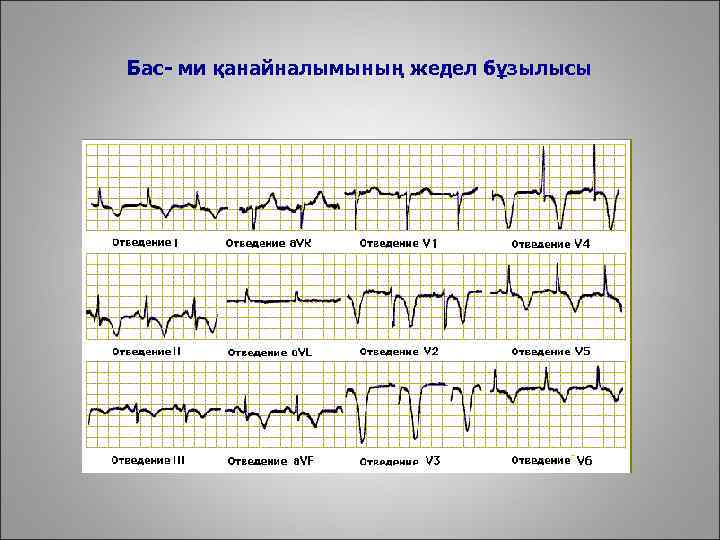 Бас- ми қанайналымының жедел бұзылысы 