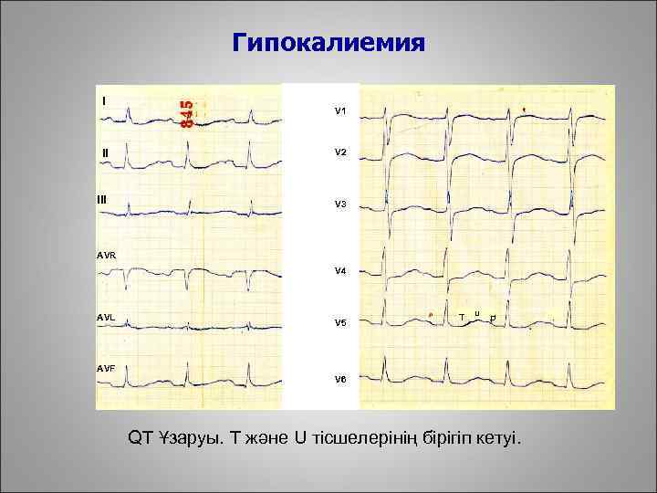Гипокалиемия I V 1 II V 2 III V 3 AVR V 4 AVL