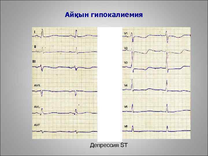 Айқын гипокалиемия I V 1 II V 2 III V 3 AVR V 4