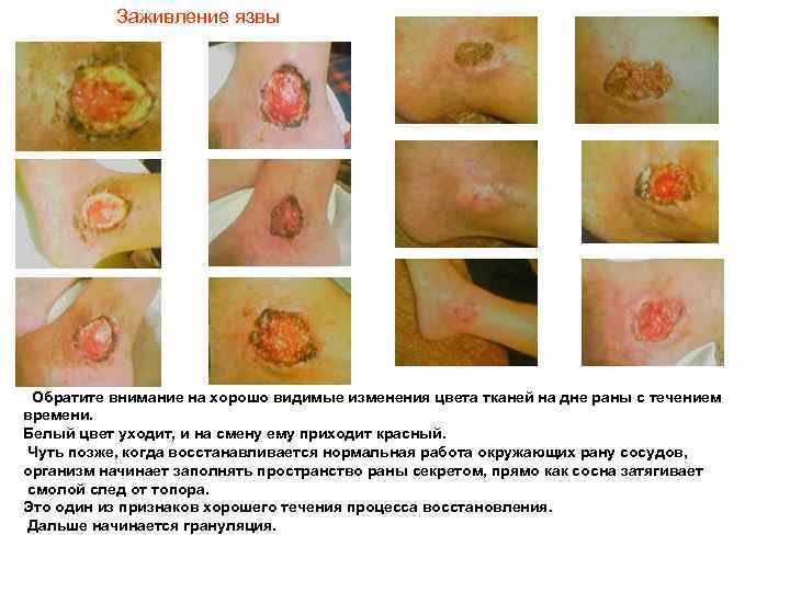 Заживление язвы Обратите внимание на хорошо видимые изменения цвета тканей на дне раны с