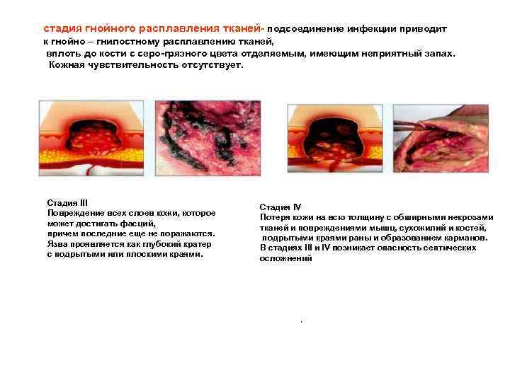 стадия гнойного расплавления тканей- подсоединение инфекции приводит к гнойно – гнилостному расплавлению тканей, вплоть