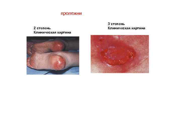 пролежни 2 степень Клиническая картина 3 степень Клиническая картина 