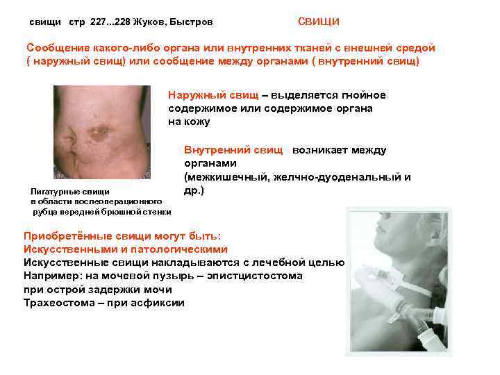 свищи стр 227. . . 228 Жуков, Быстров свищи Сообщение какого-либо органа или внутренних