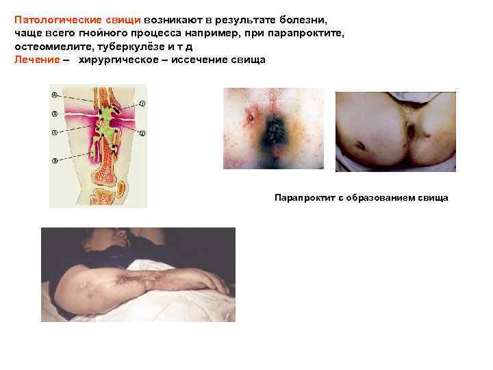 Патологические свищи возникают в результате болезни, чаще всего гнойного процесса например, при парапроктите, .