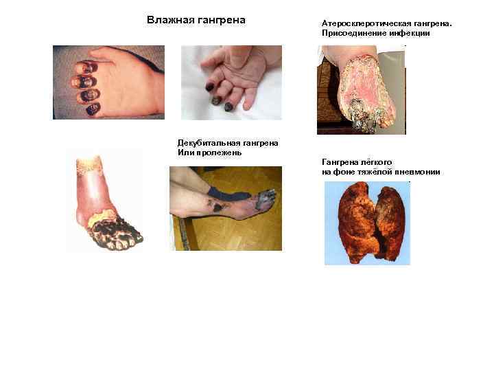 Влажная гангрена Атеросклеротическая гангрена. Присоединение инфекции Декубитальная гангрена Или пролежень Гангрена лёгкого на фоне