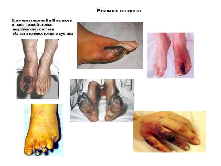 Влажная гангрена II и III пальцев и тыла правой стопы; выражен отек стопы и