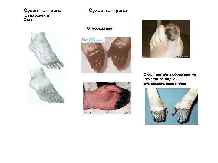 Сухая гангрена Отморожение Ожог Отморожение Сухая гангрена обеих кистей, отчетливо видна демаркационная линия. 