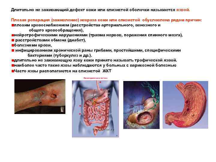 Длительно не заживающий дефект кожи или слизистой оболочки называется язвой. Плохая репарация (заживление) некроза