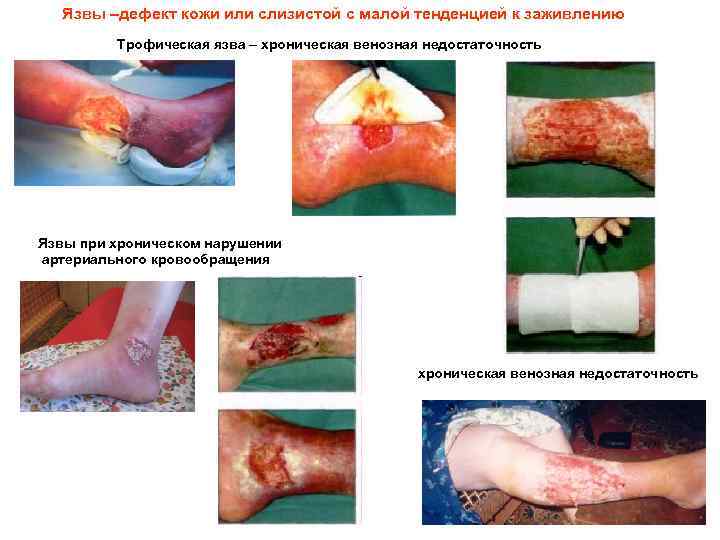 Язвы –дефект кожи или слизистой с малой тенденцией к заживлению Трофическая язва – хроническая