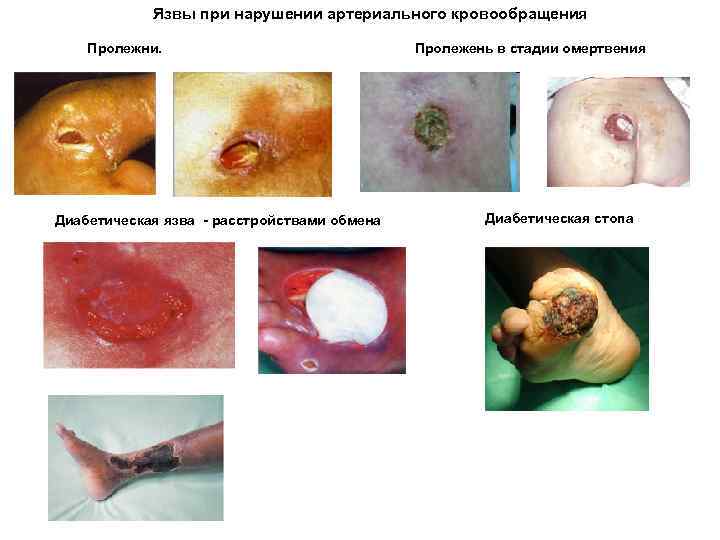 Язвы при нарушении артериального кровообращения Пролежни. Диабетическая язва - расстройствами обмена Пролежень в стадии