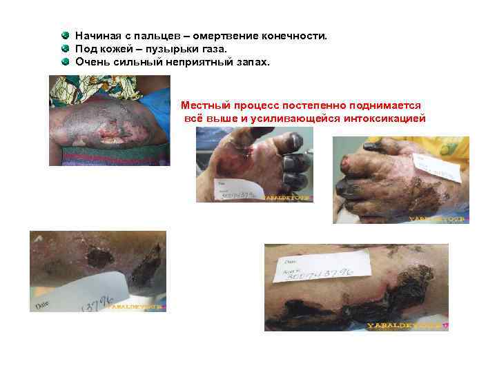Начиная с пальцев – омертвение конечности. Под кожей – пузырьки газа. Очень сильный неприятный