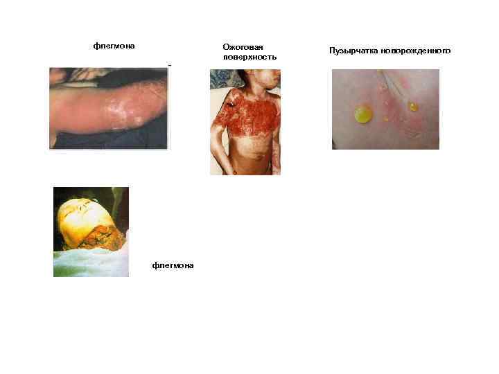 флегмона Ожоговая поверхность флегмона Пузырчатка новорожденного 