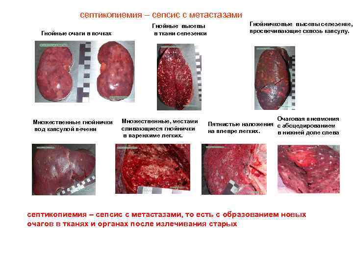 септикопиемия – сепсис с метастазами Гнойные очаги в почках Множественные гнойнички под капсулой печени