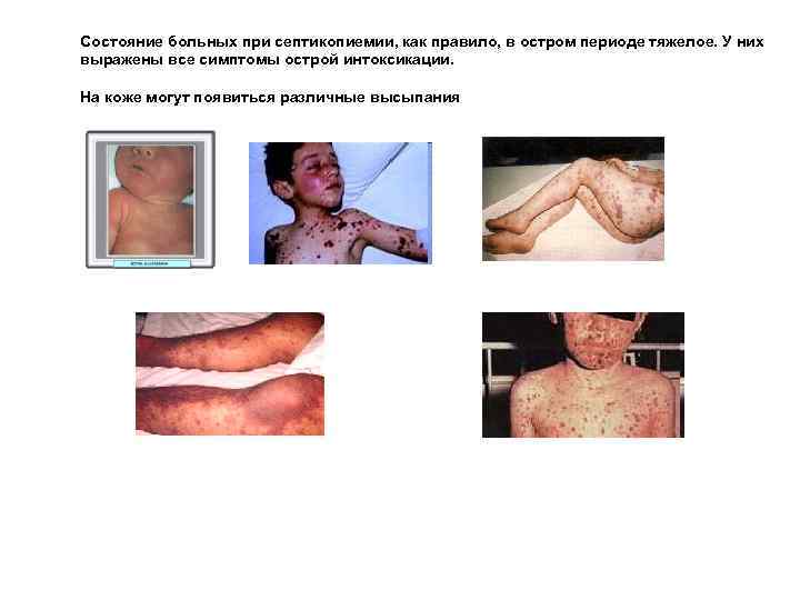 Состояние больных при септикопиемии, как правило, в остром периоде тяжелое. У них выражены все