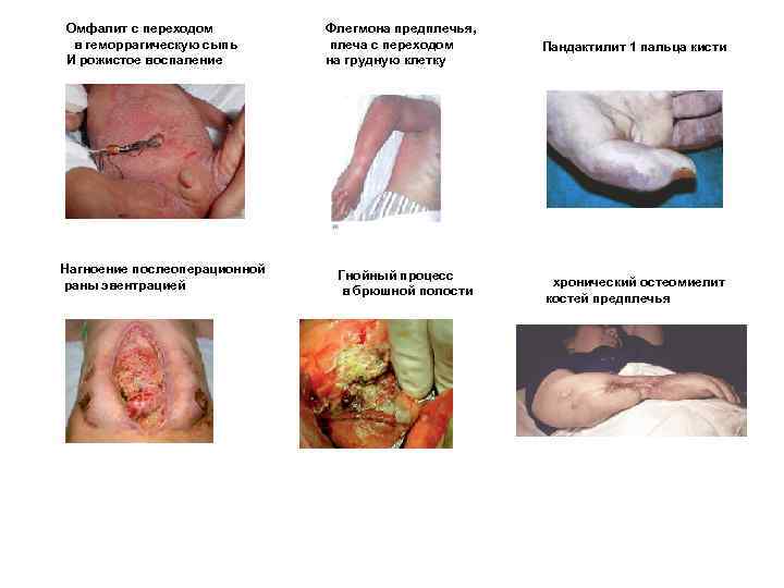 Омфалит с переходом в геморрагическую сыпь И рожистое воспаление Нагноение послеоперационной раны эвентрацией Флегмона