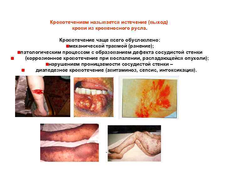 Кровотечением называется истечение (выход) крови из кровеносного русла. Кровотечение чаще всего обусловлено: механической травмой