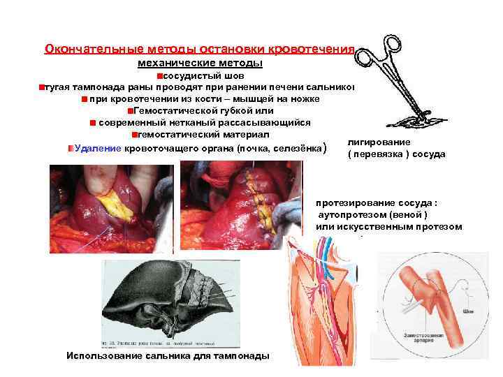 Окончательные методы остановки кровотечения. механические методы сосудистый шов тугая тампонада раны проводят при ранении