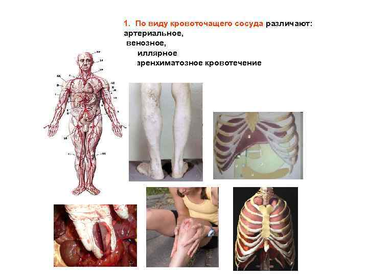 1. По виду кровоточащего сосуда различают: артериальное, венозное, капиллярное и паренхиматозное кровотечение 