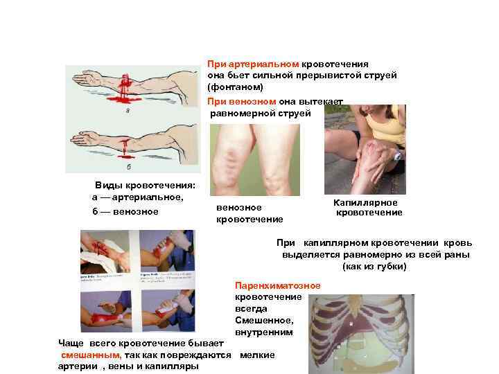  При артериальном кровотечения она бьет сильной прерывистой струей (фонтаном) При венозном она вытекает