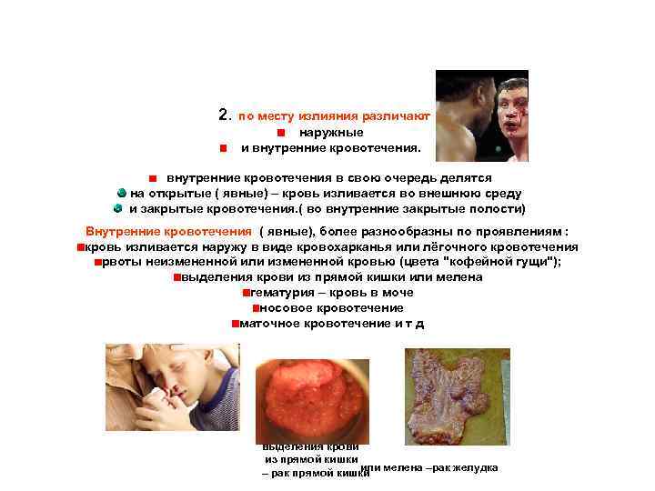  2. по месту излияния различают наружные и внутренние кровотечения в свою очередь делятся