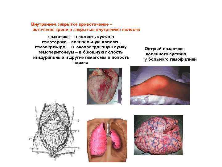 Внутреннее закрытое кровотечение – истечение крови в закрытые внутренние полости гемартроз – в полость