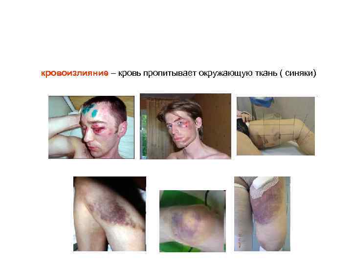 кровоизлияние – кровь пропитывает окружающую ткань ( синяки) 