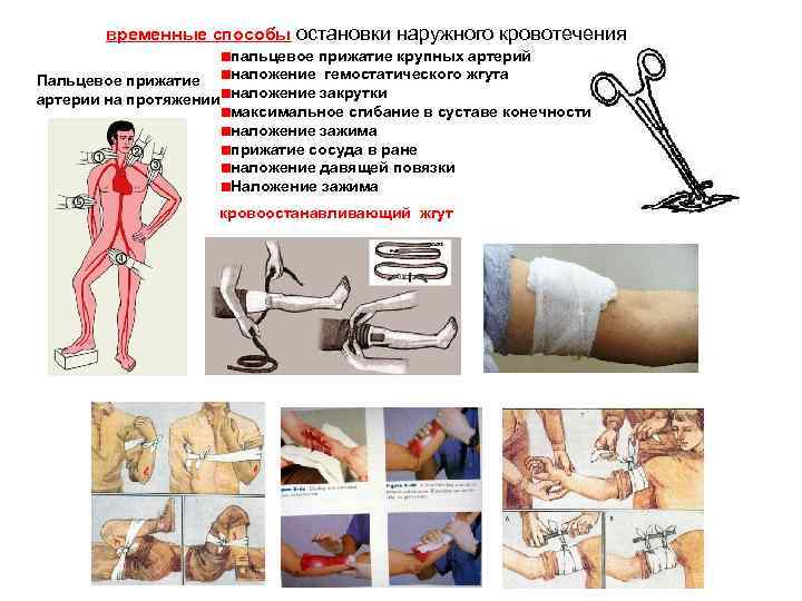 временные способы остановки наружного кровотечения пальцевое прижатие крупных артерий наложение гемостатического жгута Пальцевое прижатие