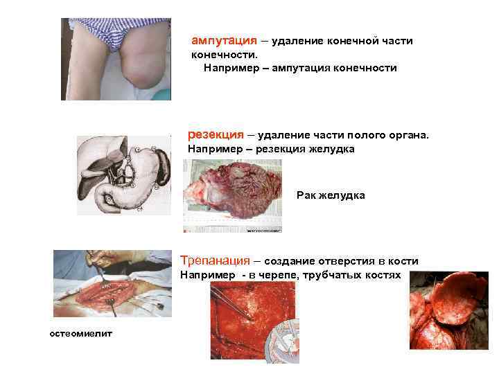 ампутация – удаление конечной части конечности. Например – ампутация конечности резекция – удаление части