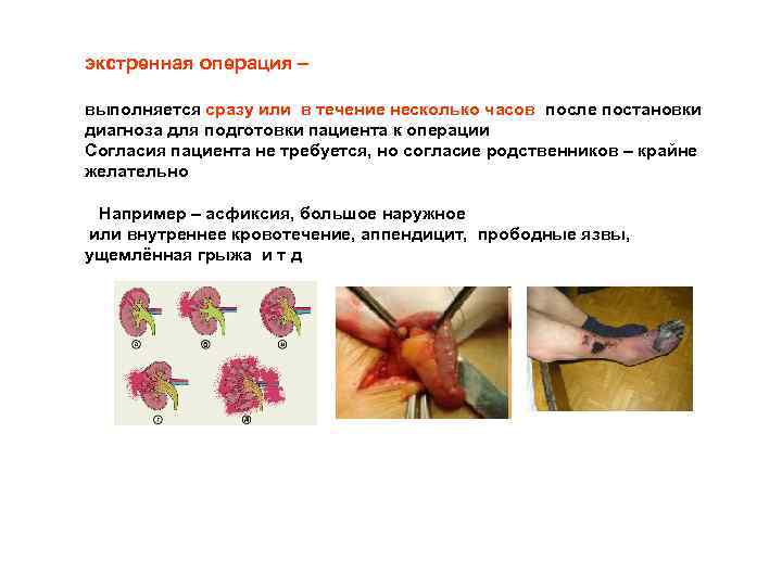 экстренная операция – выполняется сразу или в течение несколько часов после постановки диагноза для