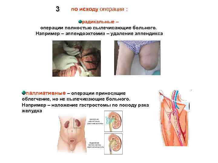 3 по исходу операции : радикальные – операции полностью вылечивающие больного. Например – аппендоэктомия