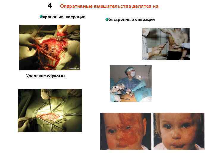 4 Оперативные вмешательства делятся на: кровавые операции Удаление саркомы бескровные операции 