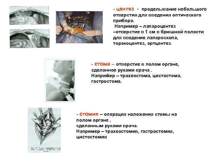 - центез - проделывание небольшого отверстия для введения оптического прибора. Например – лапароцентез –отверстие