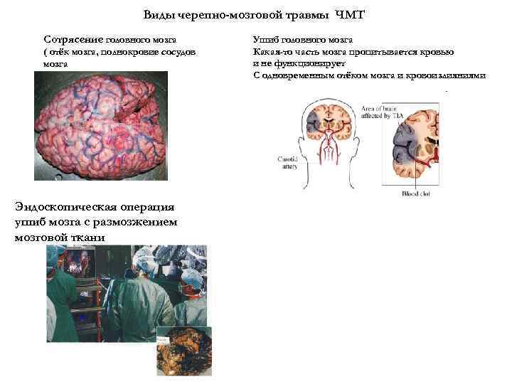 Виды черепно-мозговой травмы ЧМТ Сотрясение головного мозга ( отёк мозга, полнокровие сосудов мозга Эндоскопическая