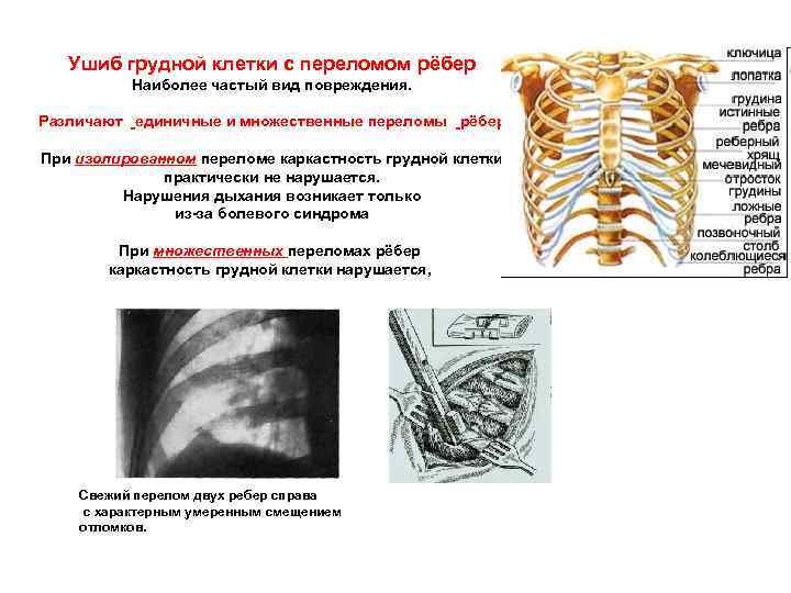 Ушиб грудной клетки с переломом рёбер Наиболее частый вид повреждения. Различают единичные и множественные