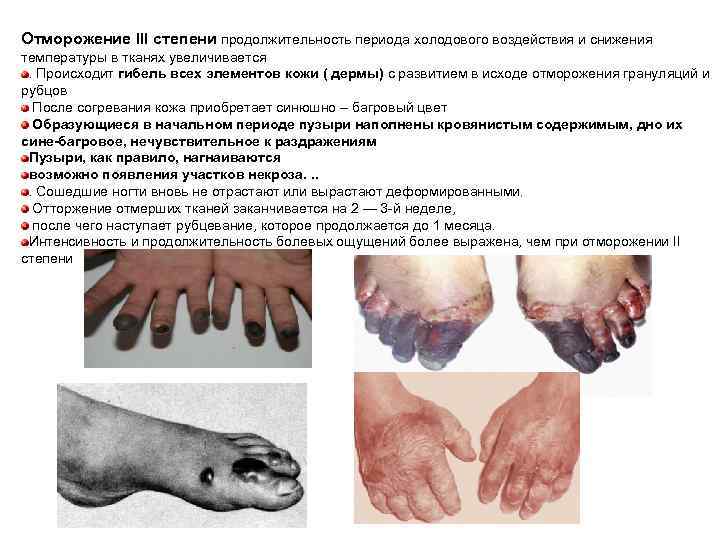 Отморожение III степени продолжительность периода холодового воздействия и снижения температуры в тканях увеличивается .