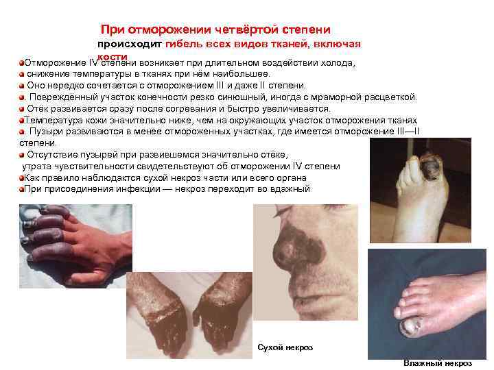  При отморожении четвёртой степени происходит гибель всех видов тканей, включая кости Отморожение IV
