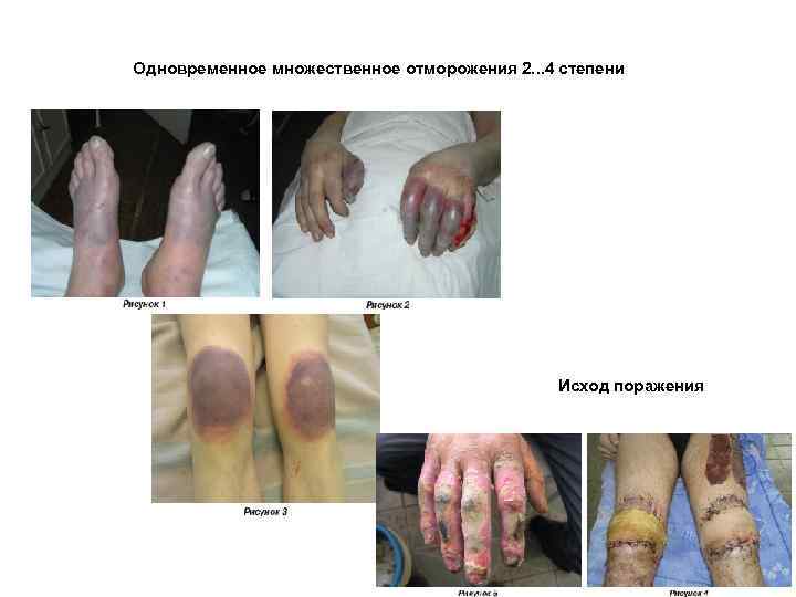 Одновременное множественное отморожения 2. . . 4 степени Исход поражения 