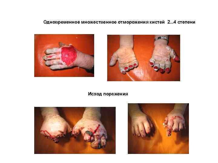 Одновременное множественное отморожения кистей 2. . . 4 степени Исход поражения 